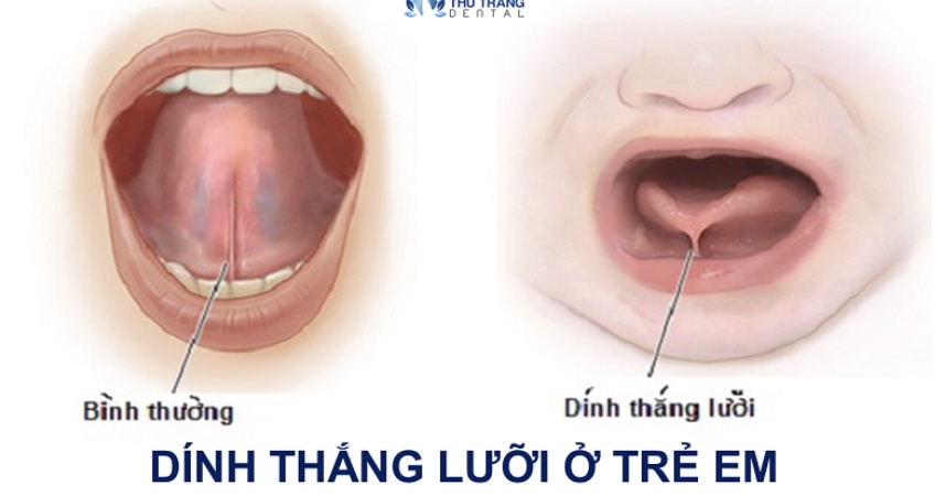 Dính thắng lưỡi ở trẻ sơ sinh