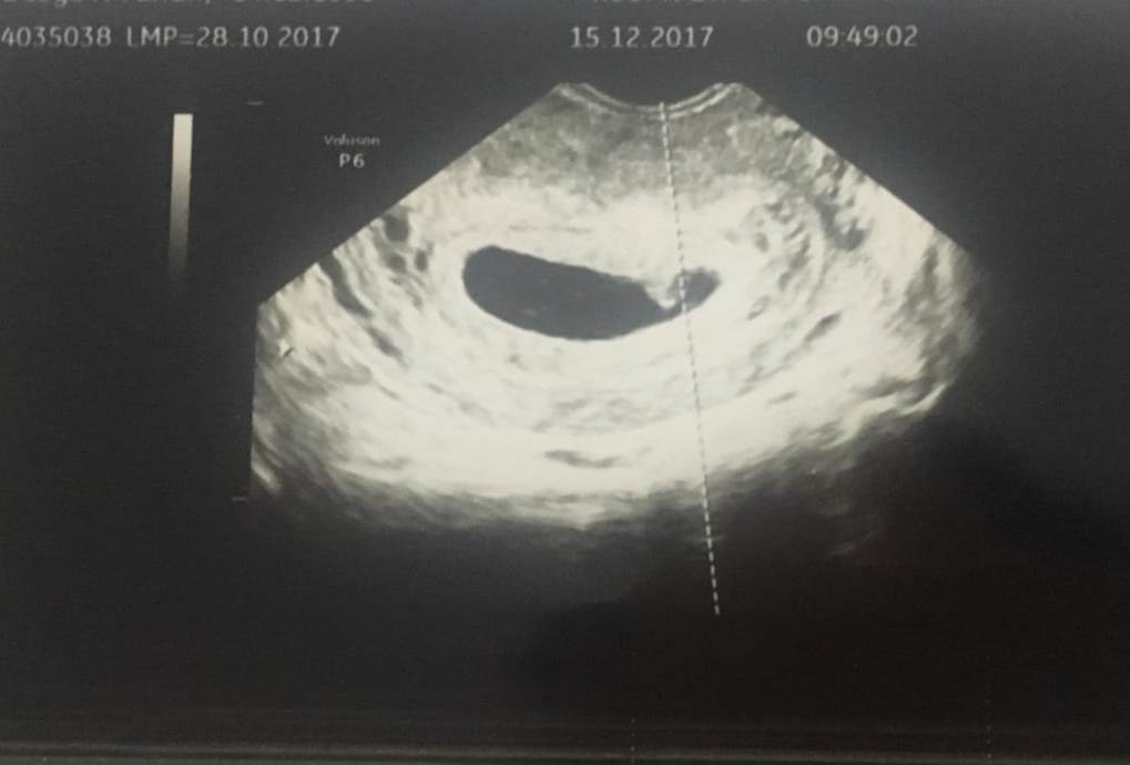 Kehamilan Pertamaku: Kelulusan Ganda #SharingWithHS