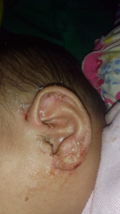 Luka sepertj melepuh di bagian telinga bayi
