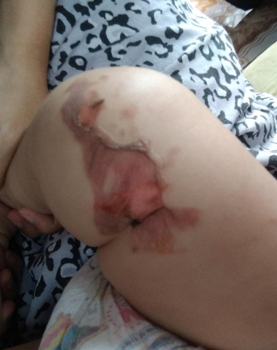 Luka bakar tersiram air panas pada bayi 7 bulan