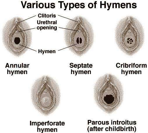 Dok klo selaput dara itu bentuknya berbeda atau sama setiap cewe