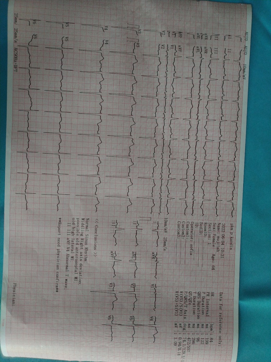 Mohon di bacakan hasil ekg berikut