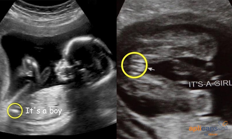 Hình ảnh siêu âm bộ phận sinh dục bé trai