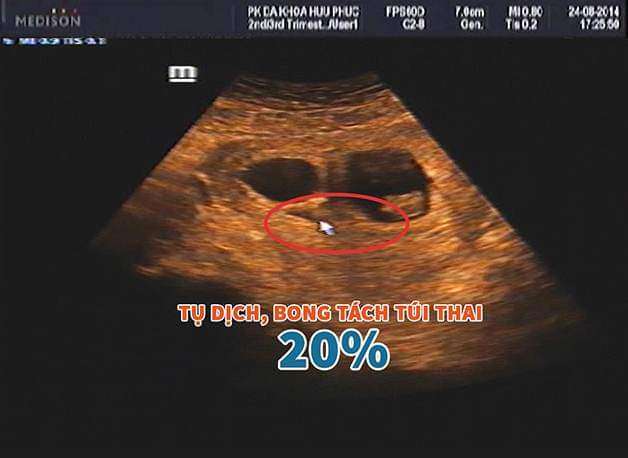 Hình ảnh siêu âm bóc tách túi thai