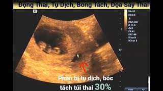 Hình ảnh siêu âm bóc tách túi thai
