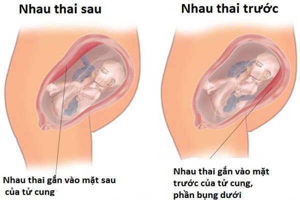 Nhau thai bám mặt sau có bình thường không?