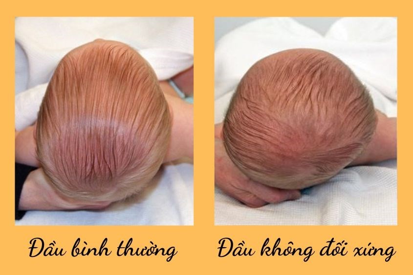 Cách chữa méo đầu cho trẻ 3 tháng tuổi