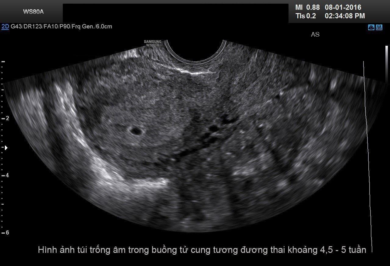 Hình ảnh túi thai 4 tuần tuổi qua máy siêu âm - HelloBacsi