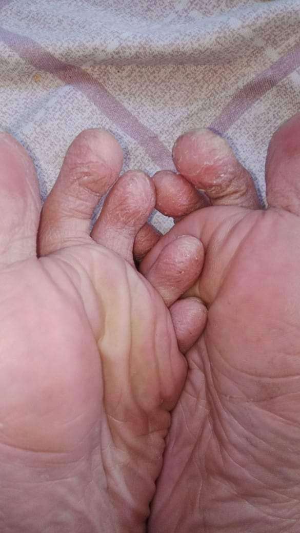 Foot disease 