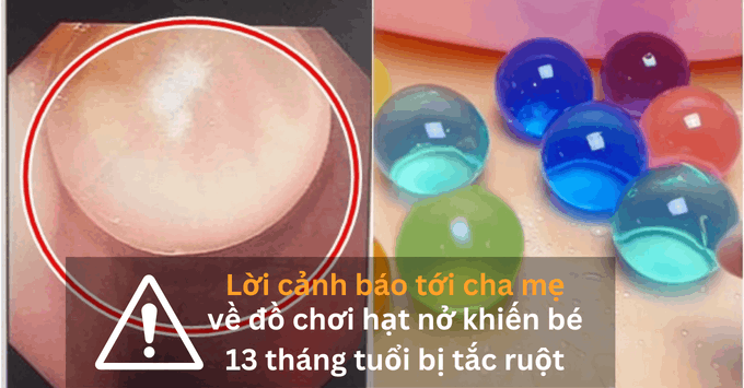 Lời cảnh báo tới cha mẹ về đồ chơi hạt nở khiến bé 13 tháng tuổi bị tắc ruột 