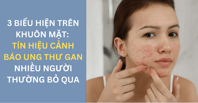 3 biểu hiện trên khuôn mặt: Tín hiệu cảnh báo ung thư gan nhiều người thường bỏ qua 