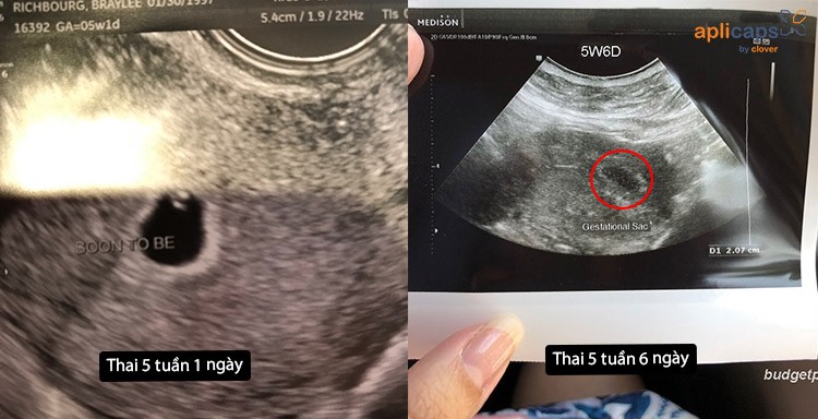 hình ảnh giấy siêu âm thai 5 tuần và giải đáp thắc mắc liên quan ...