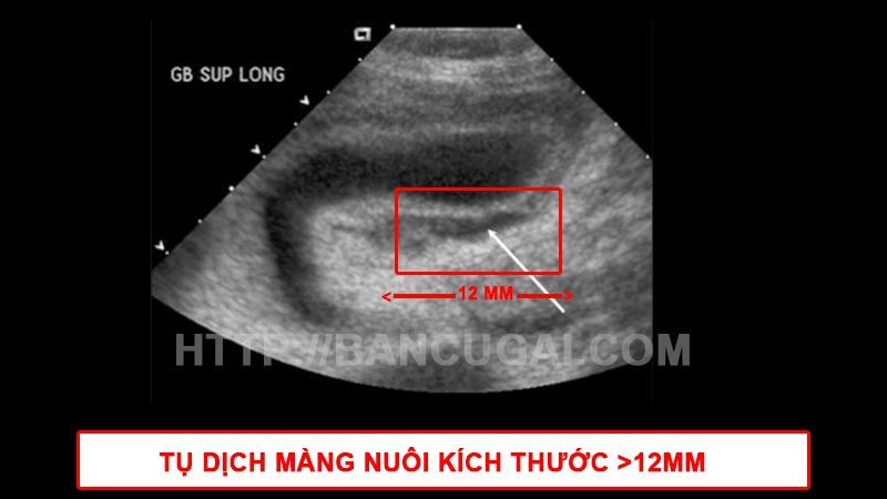 Giải đáp thắc mắc: tụ dịch màng nuôi bao nhiêu mm là nguy hiểm? Tụ dịch màng nuôi 22 mm ảnh hưởng như thế nào? 