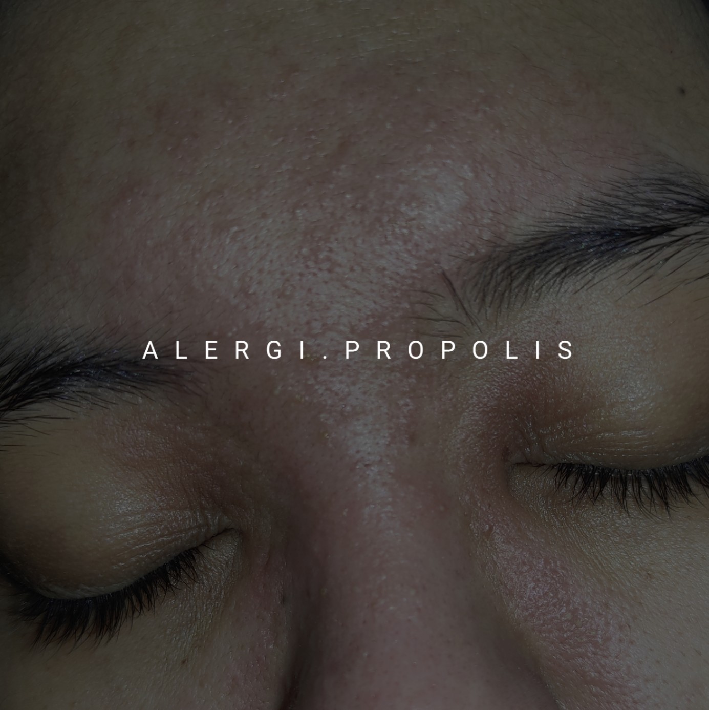 Alergi Propolis - HelloSehat