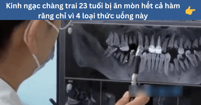 Hoảng hốt trước 4 loại đồ uống thường ngày khiến chàng trai 23 tuổi bị ăn mòn hết cả hàm răng