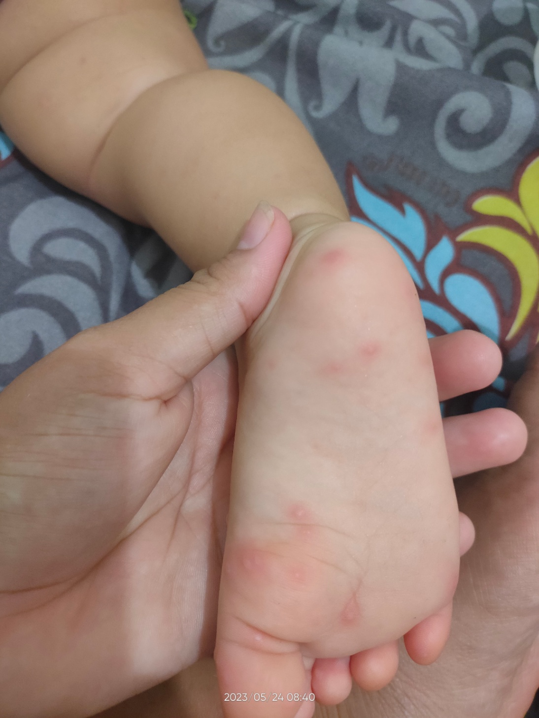 apakah ini merupakan monkeypox 