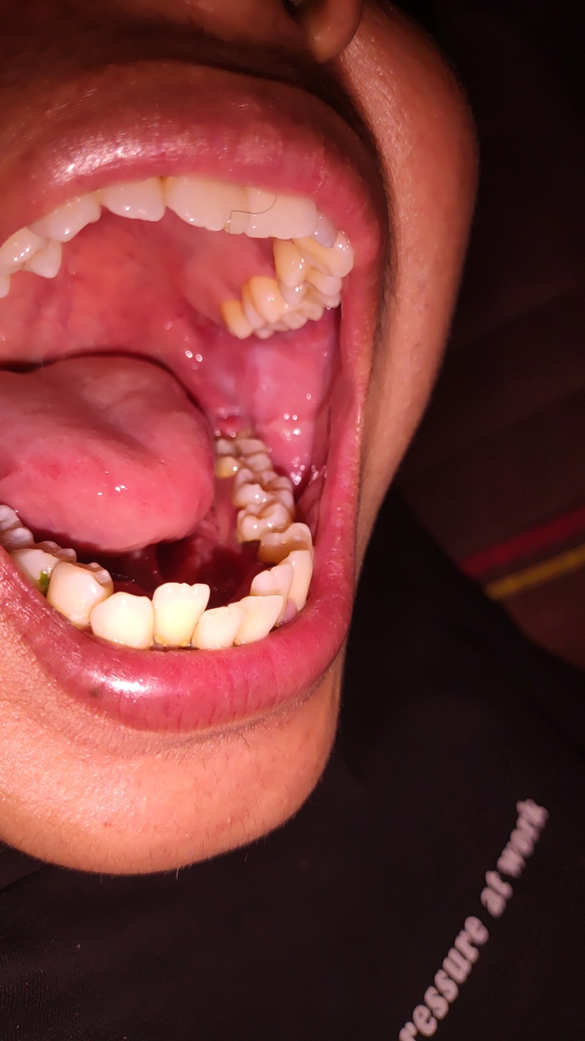 gusi menutupi gigi dan luka di lidah samping.