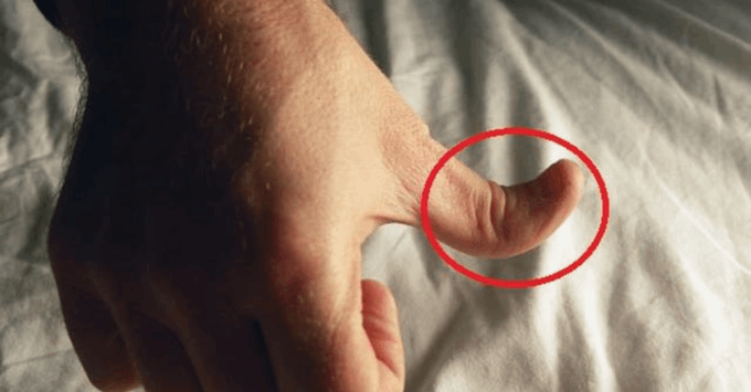 Phát hiện bệnh lạ nhờ kiểm tra ngón tay, nếu thấy 6 bất thường này cảnh báo nhiều bệnh nặng