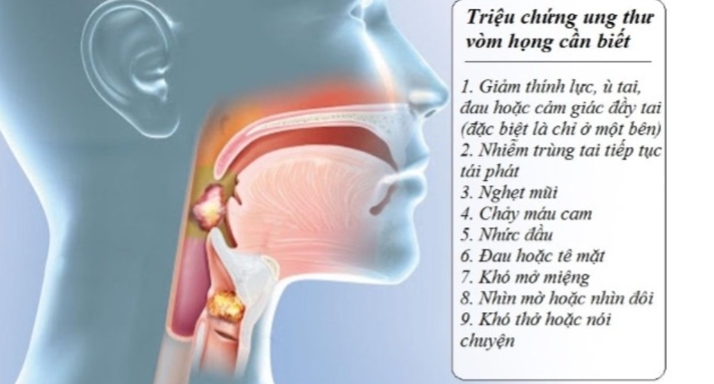 Ung thư vòm họng - Nguyên nhân, triệu chứng, và cách phòng tránh