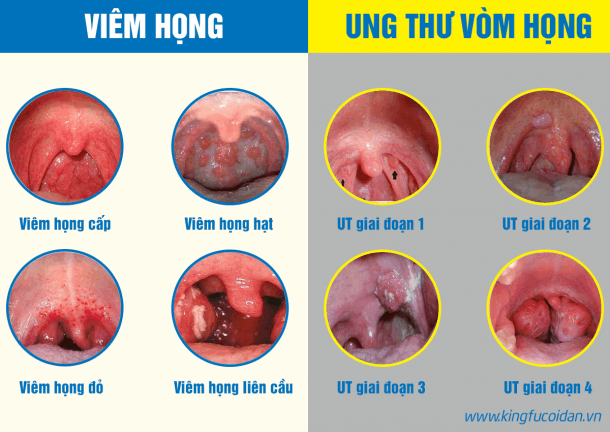 Hình ảnh ung thư vòm họng giai đoạn 1 - HelloBacsi