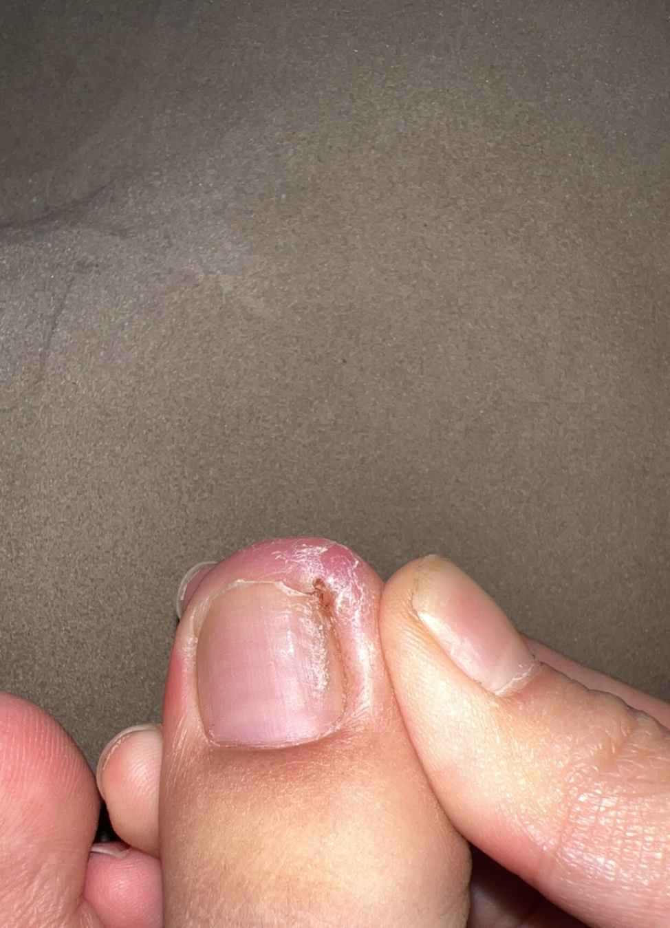 Ingrown Toenails (for Teens)