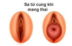 Sa tử cung khi mang thai