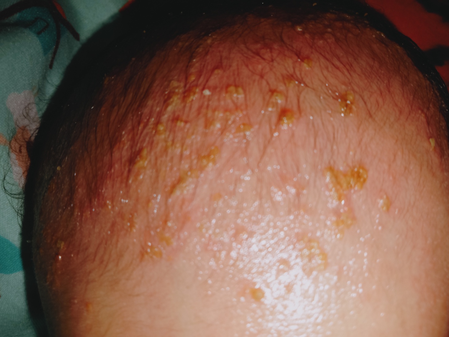 Dermatitis seboroik