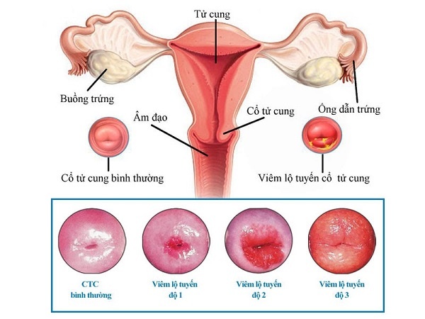 Hình ảnh cô bé bị viêm chị em nên biết