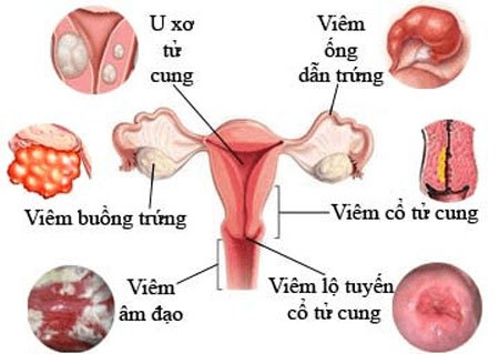 Hình ảnh cô bé bị viêm chị em nên biết