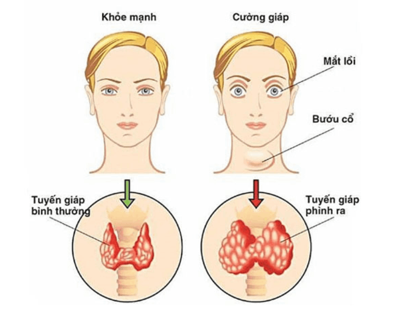 Bệnh cường giáp là gì?