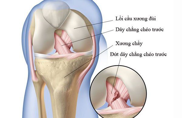 Rách dây chằng chéo trước có tự lành không?