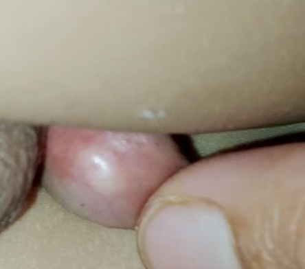 Benjolan pana penis anak