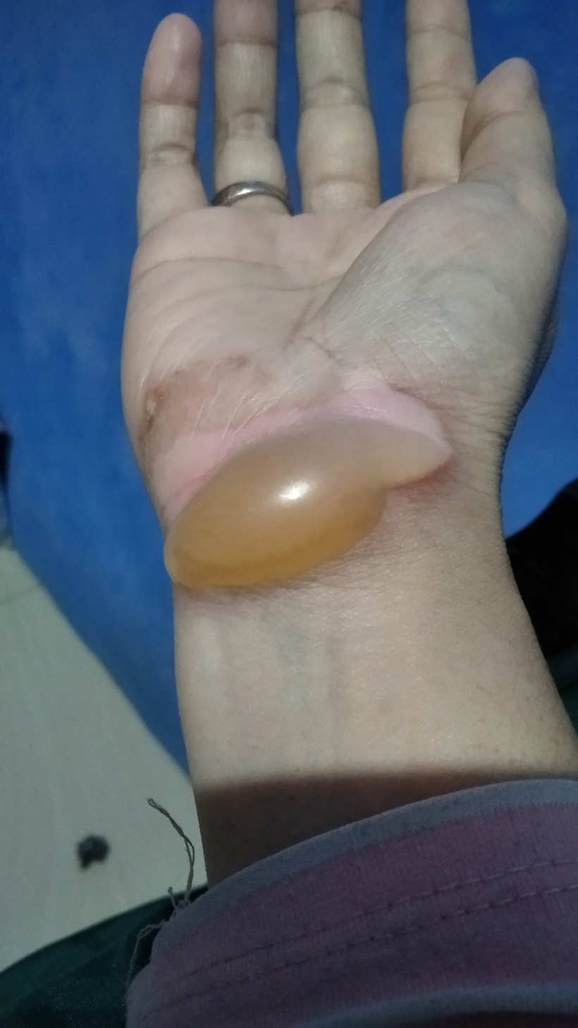 Luka bakar akibat pemakaian obat oles