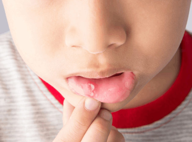 5 cách chữa nhiệt miệng cho trẻ tại nhà hiệu quả 