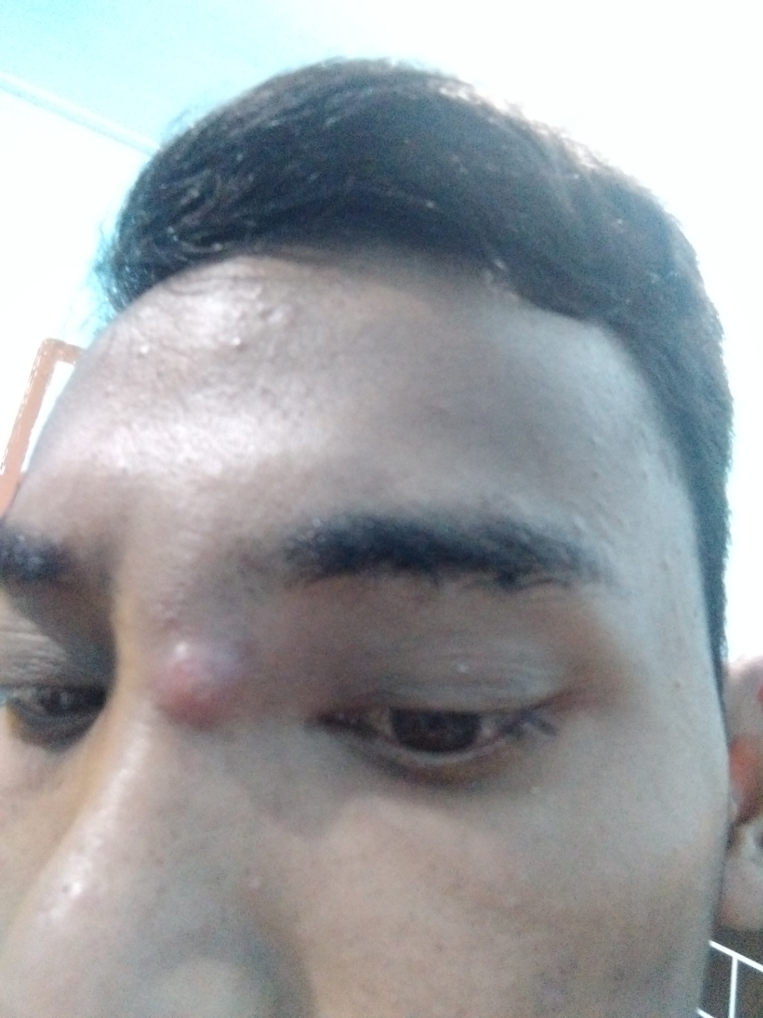 benjolan di hidung 