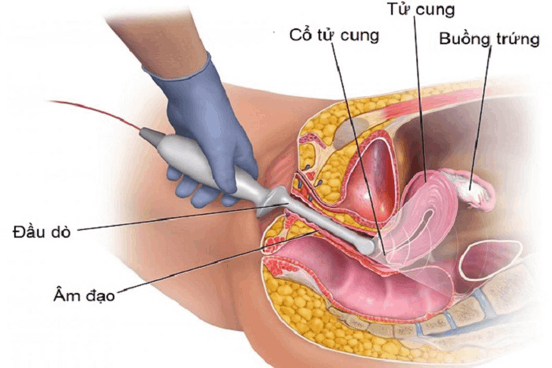 Siêu âm đầu dò là gì? Có gây mất trinh không?