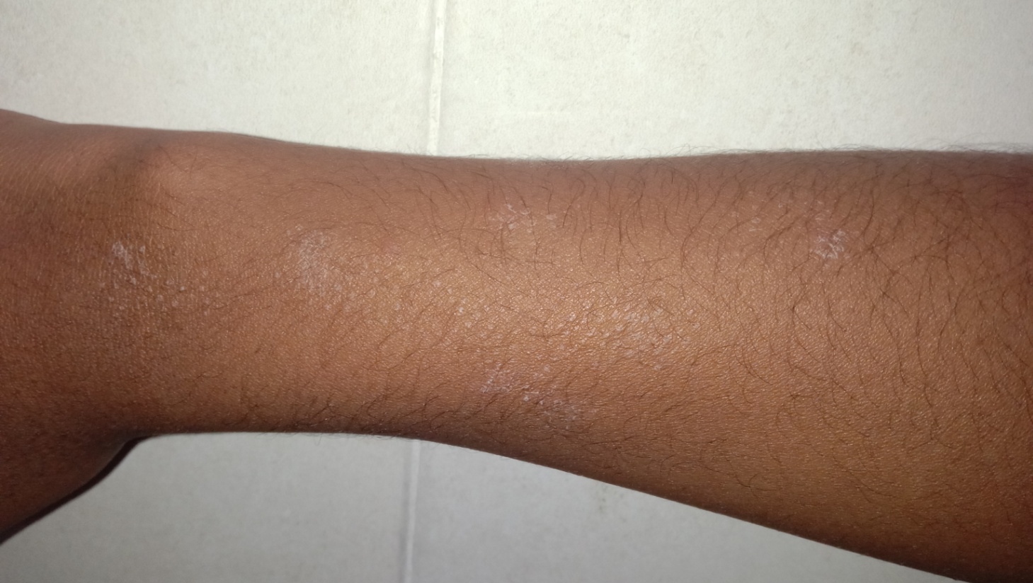 Bintik/bercak putih pada kulit tangan dan terkadang gatal