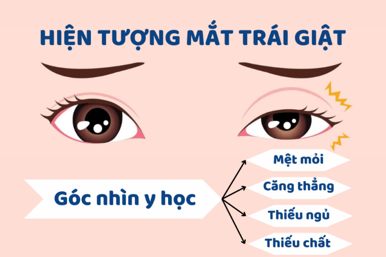 Khóe mắt trái nữ bị giật liên tục có nguy cơ mắc bệnh về mắt không?