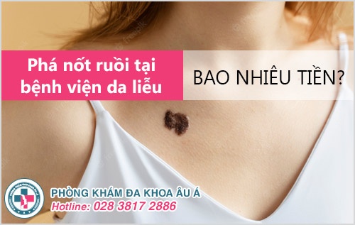 Phá nốt ruồi tại bệnh viện Da liễu: Chi phí bao nhiêu?