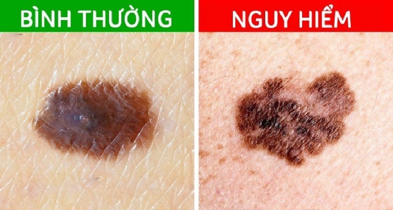 Nốt Ruồi - Bí Ẩn Thú Vị Về Vết Đốm Trên Da: Giải Mã Lý Do Tại Sao Lại Mọc Nốt Ruồi?