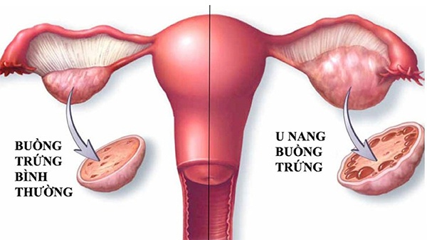 U nang buồng trứng có nguy hiểm không? Giải đáp thắc mắc cho phụ nữ