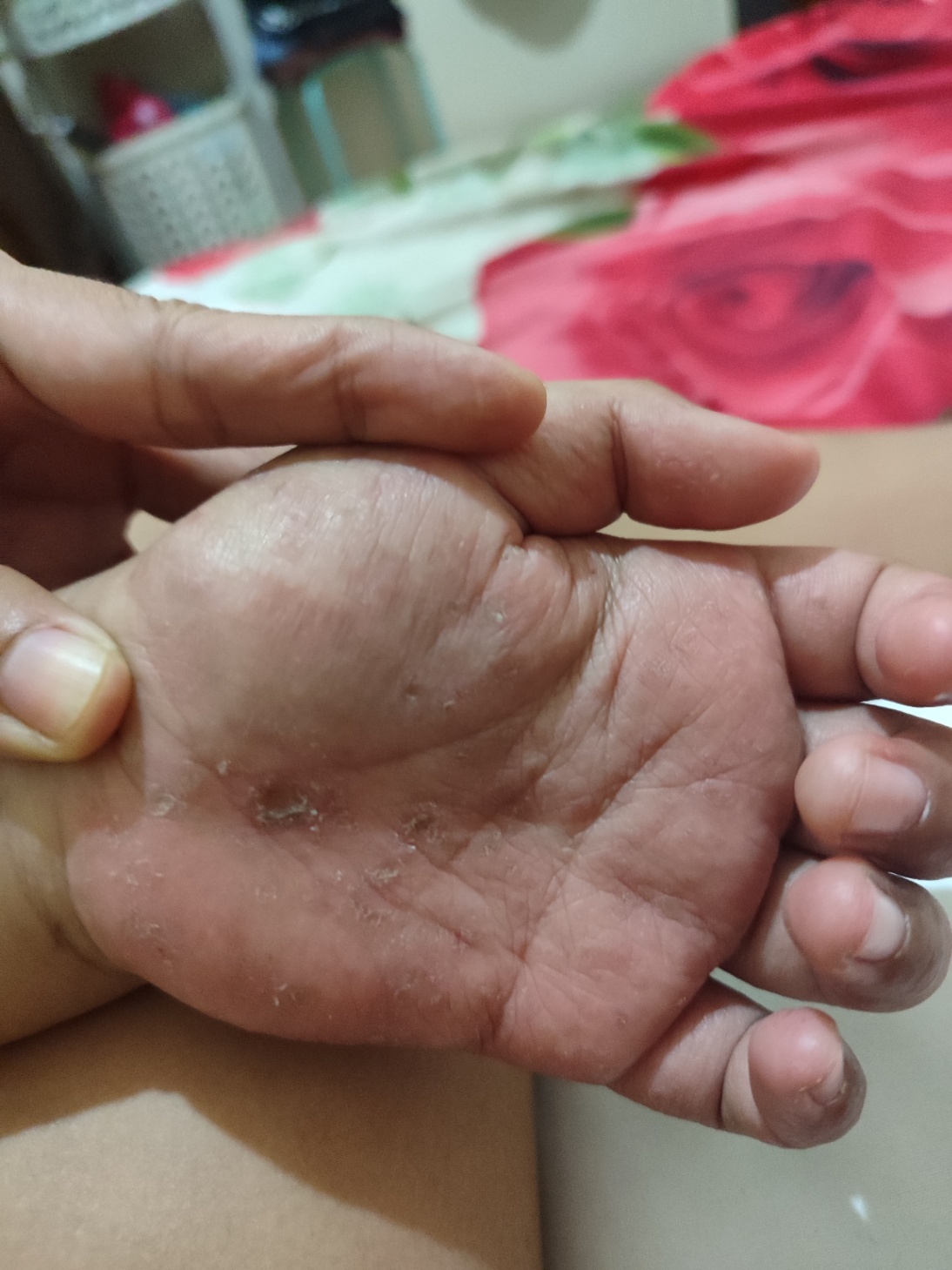 Bintik berair pada telapak tangan dan kaki