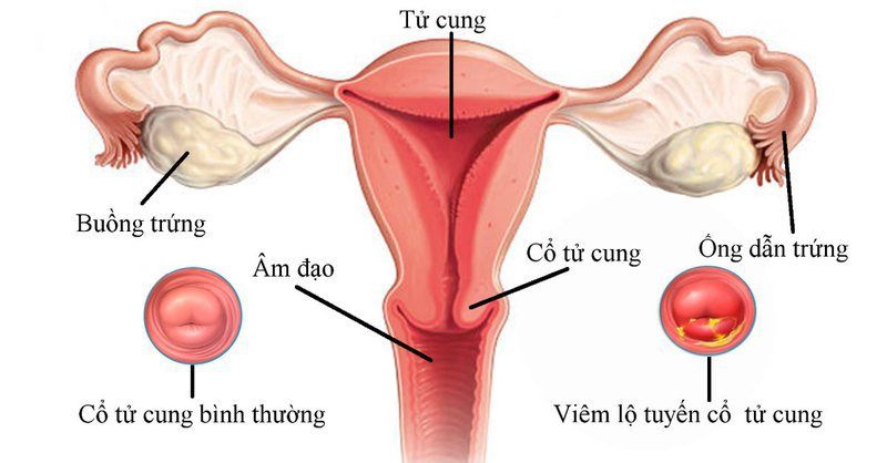 Viêm lộ tuyến là gì? Triệu chứng và phương pháp điều trị hiệu quả