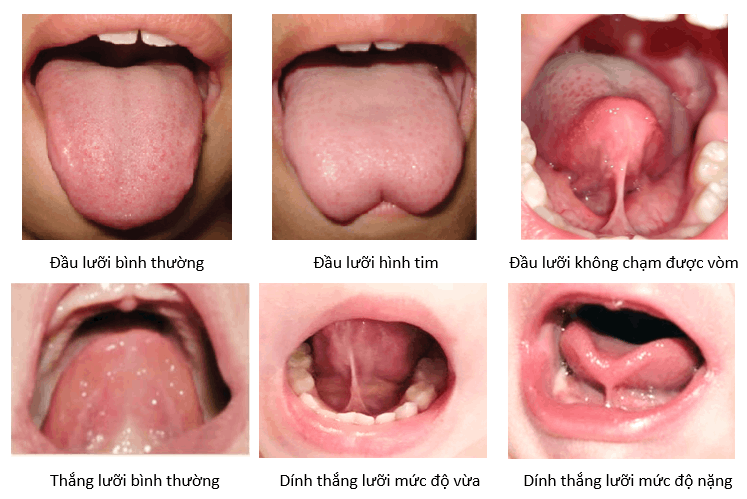 Hình ảnh lưỡi bình thường của trẻ sơ sinh trông như thế nào?