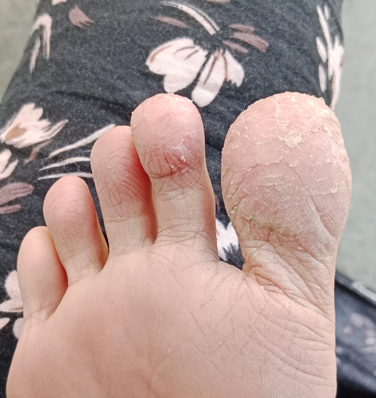 Kulit kering pada jari jari kaki