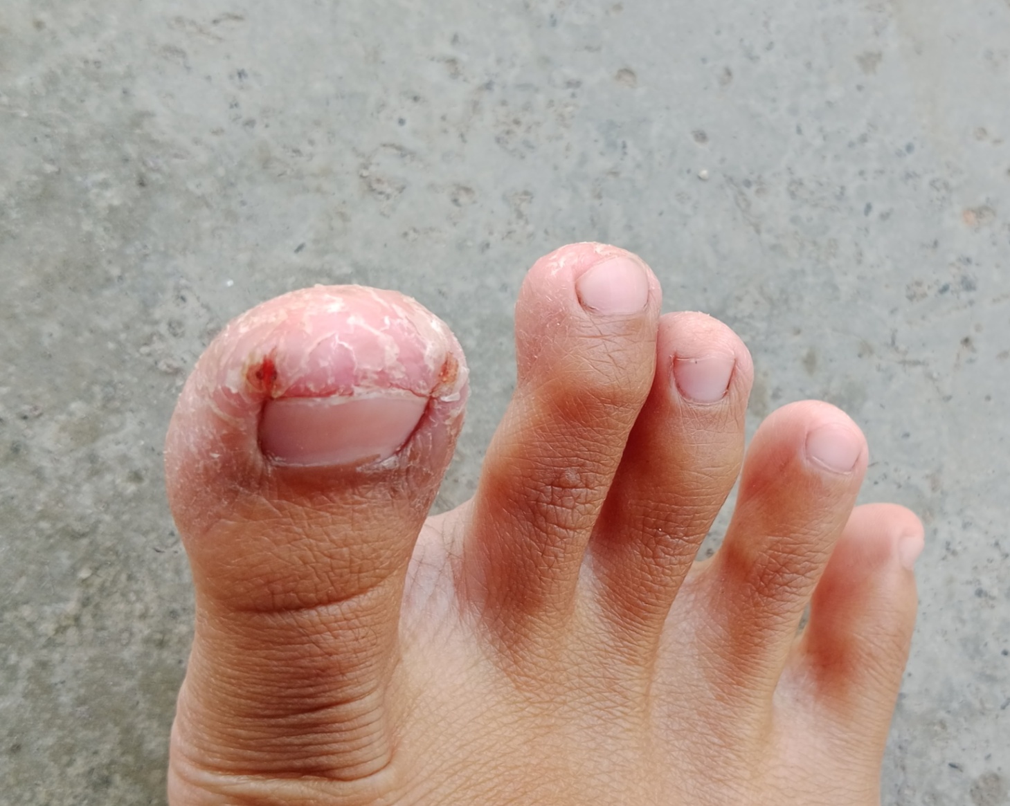 Kulit kering pada jari jari kaki