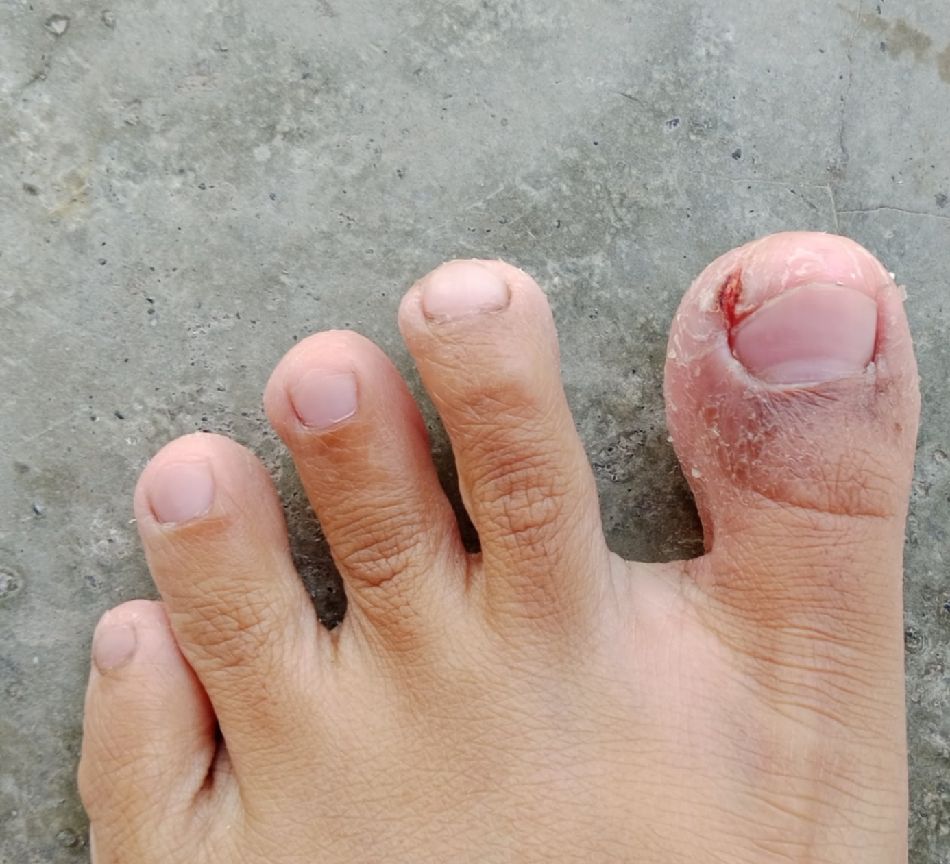 Kulit kering pada jari jari kaki