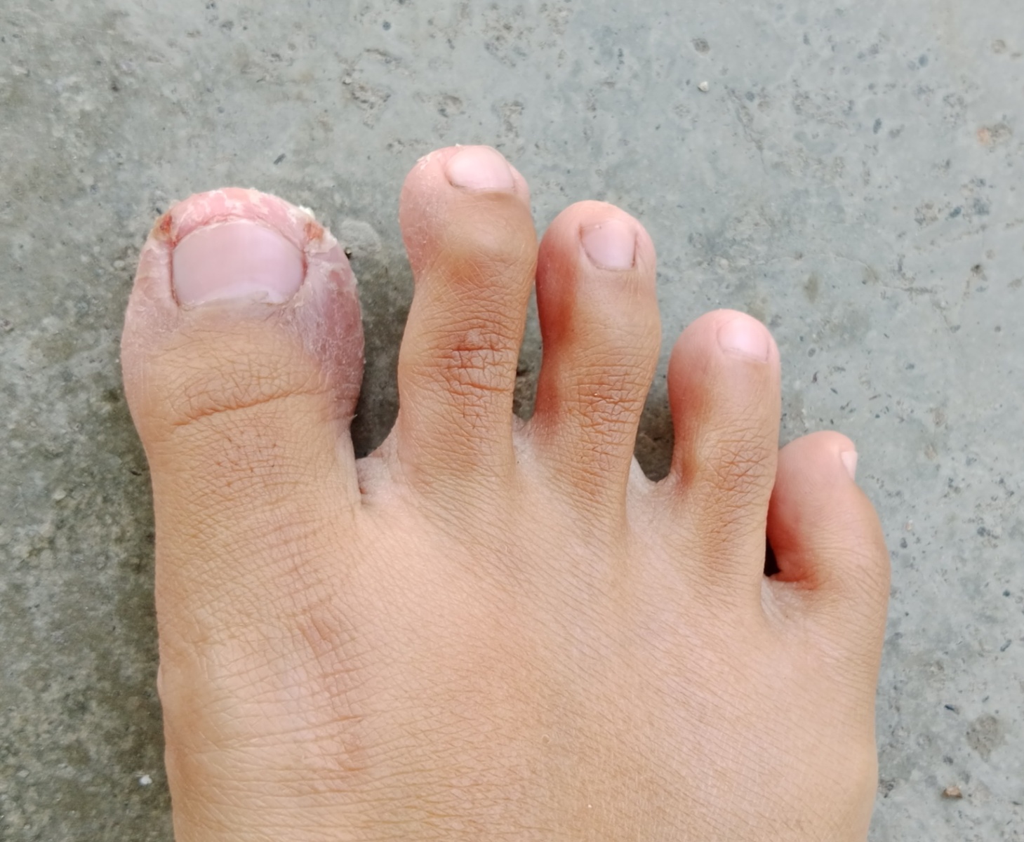 Kulit kering pada jari jari kaki