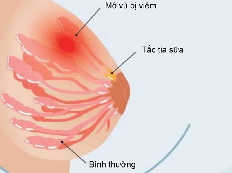 Tắc sữa làm sao cho có lại ngay? Bật mí cho mẹ 6 cách làm tan cục sữa tắc nhanh chóng