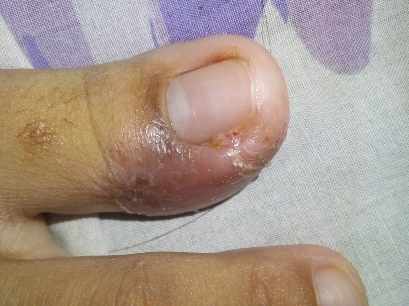 Infeksi kulit bagian jempol kaki